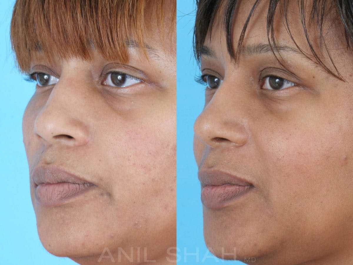 Rhinoplasty Before & After Gallery - Patient 345522 - Image 3