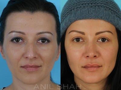 Rhinoplasty Before & After Gallery - Patient 325862 - Image 1