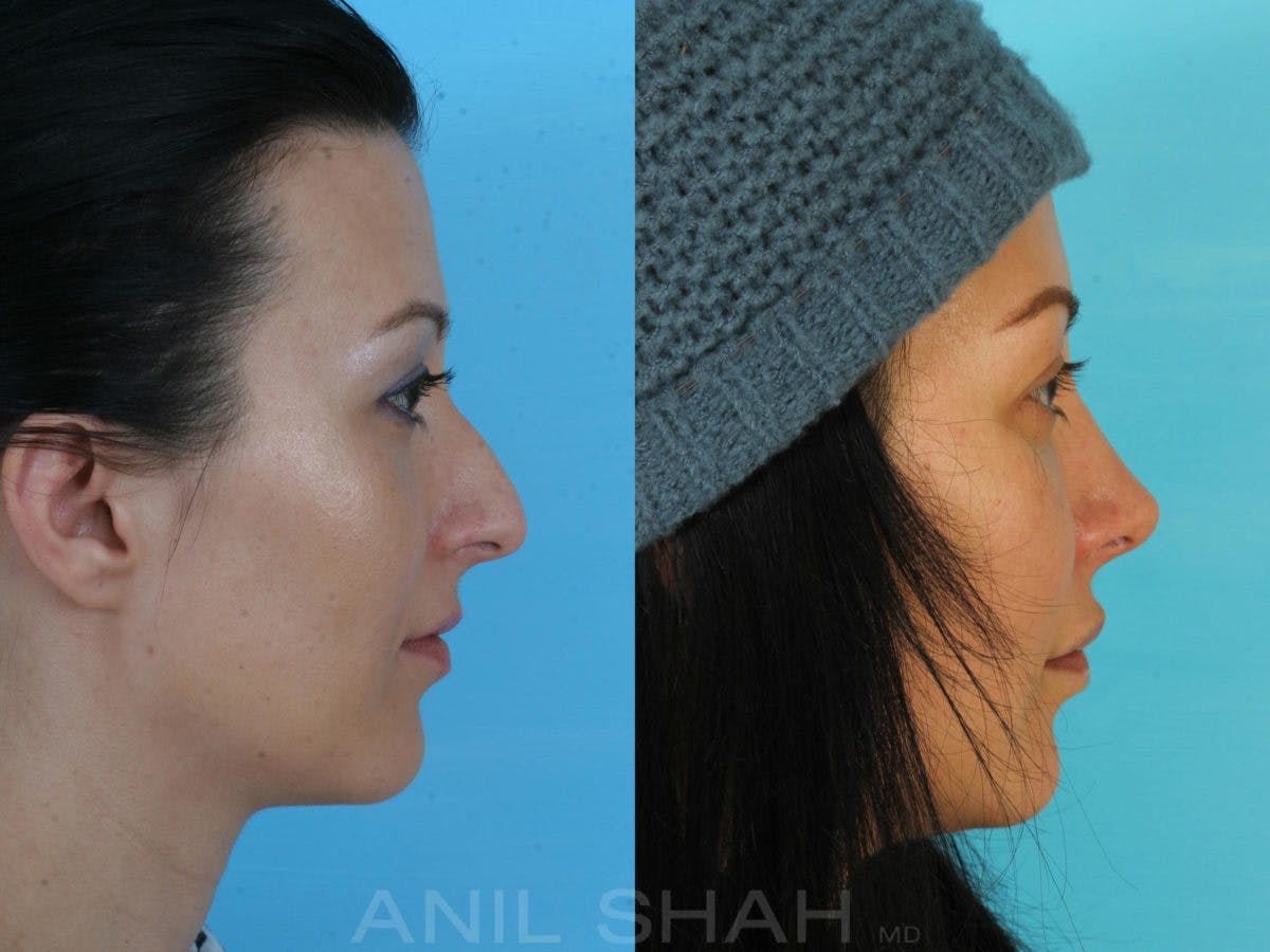 Rhinoplasty Before & After Gallery - Patient 325862 - Image 2