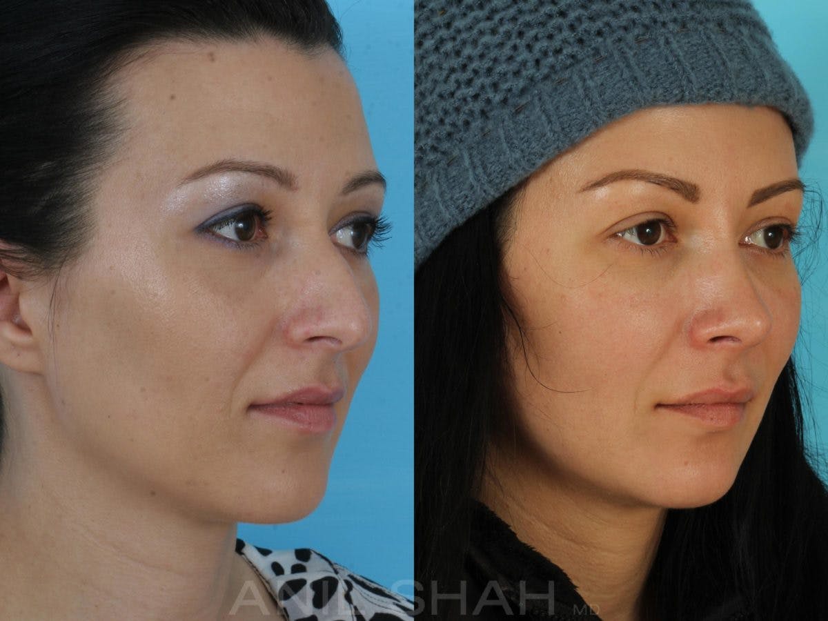 Rhinoplasty Before & After Gallery - Patient 325862 - Image 3