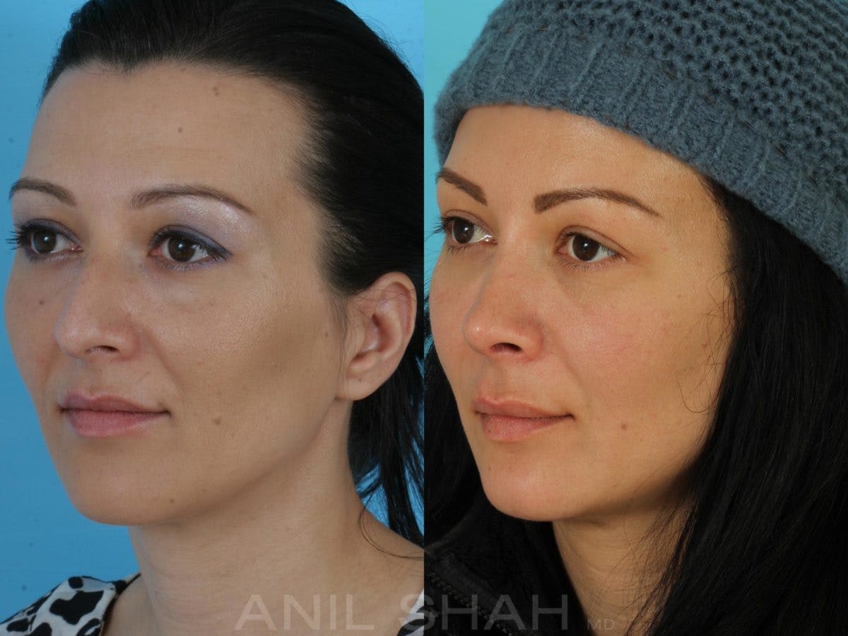 Rhinoplasty Before & After Gallery - Patient 325862 - Image 4