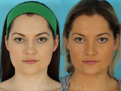 Rhinoplasty Before & After Gallery - Patient 215838 - Image 1