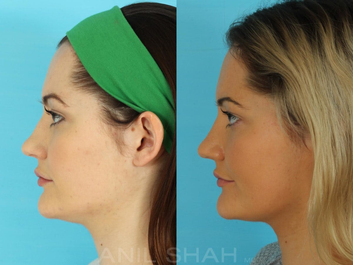 Rhinoplasty Before & After Gallery - Patient 215838 - Image 2