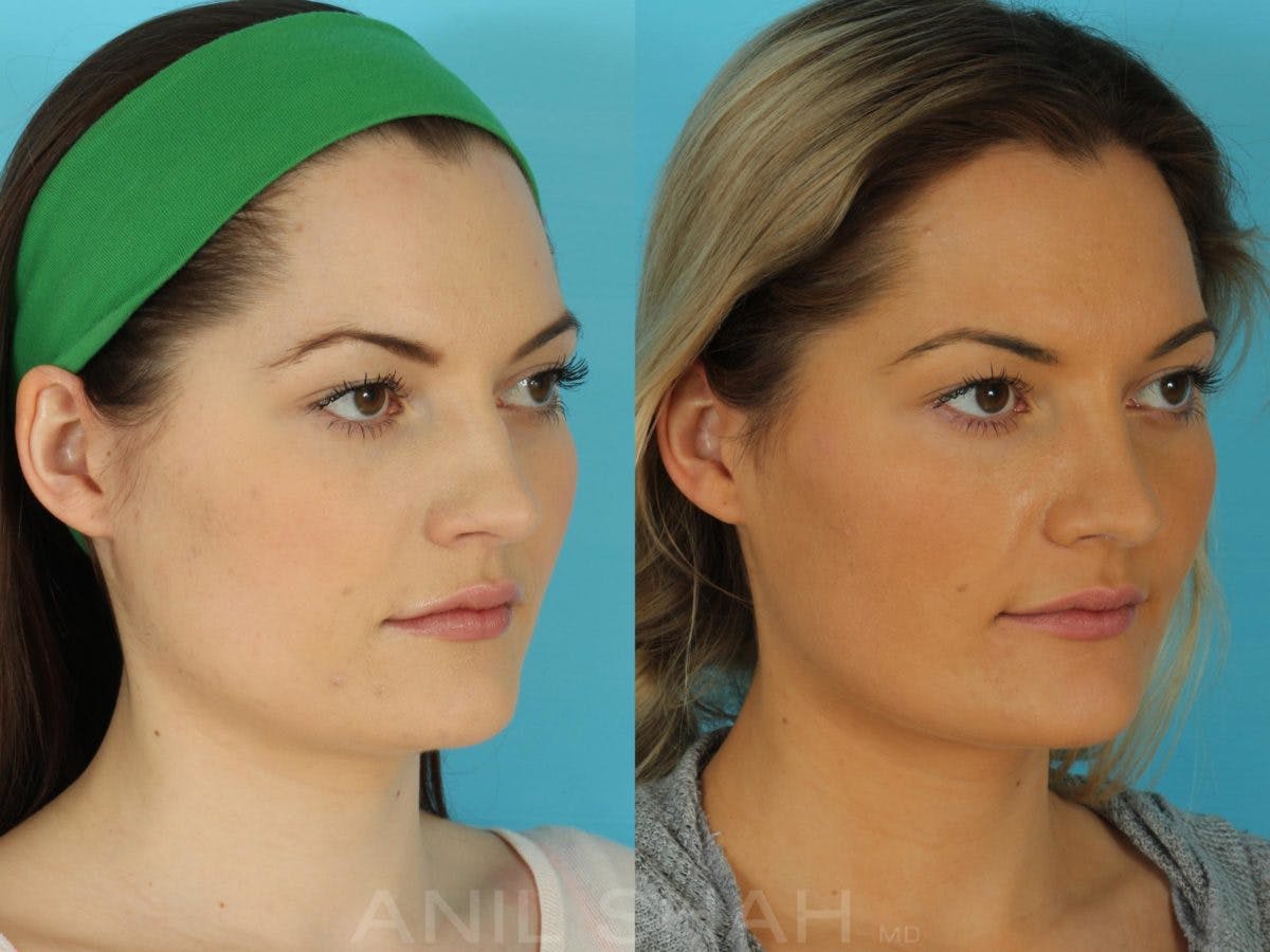 Rhinoplasty Before & After Gallery - Patient 215838 - Image 3