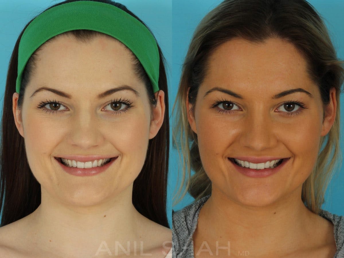 Rhinoplasty Before & After Gallery - Patient 215838 - Image 4