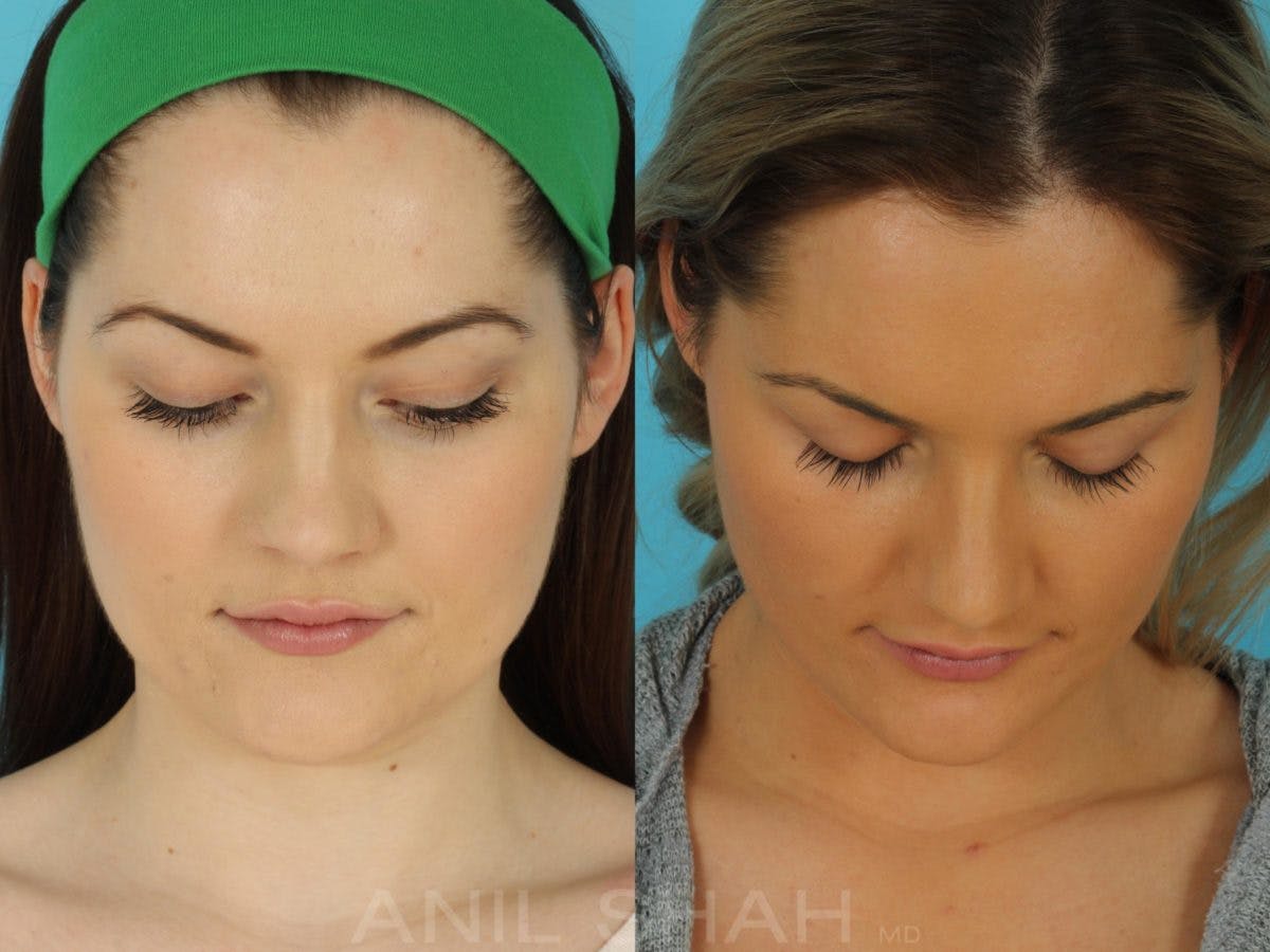 Rhinoplasty Before & After Gallery - Patient 215838 - Image 5