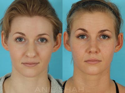 Rhinoplasty Before & After Gallery - Patient 506029 - Image 1