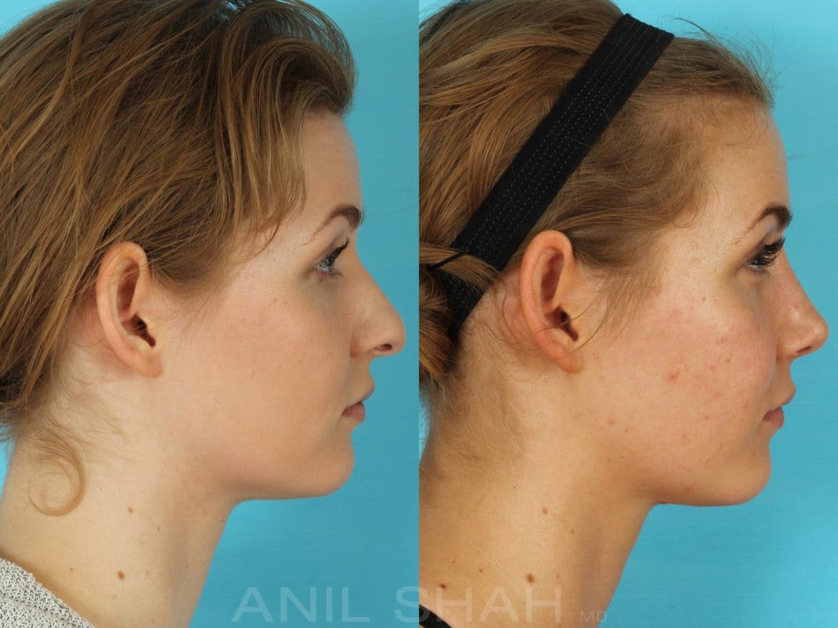 Rhinoplasty Before & After Gallery - Patient 506029 - Image 2