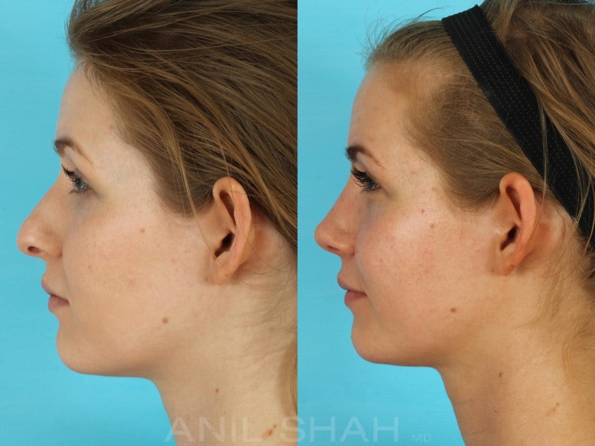 Rhinoplasty Before & After Gallery - Patient 506029 - Image 3