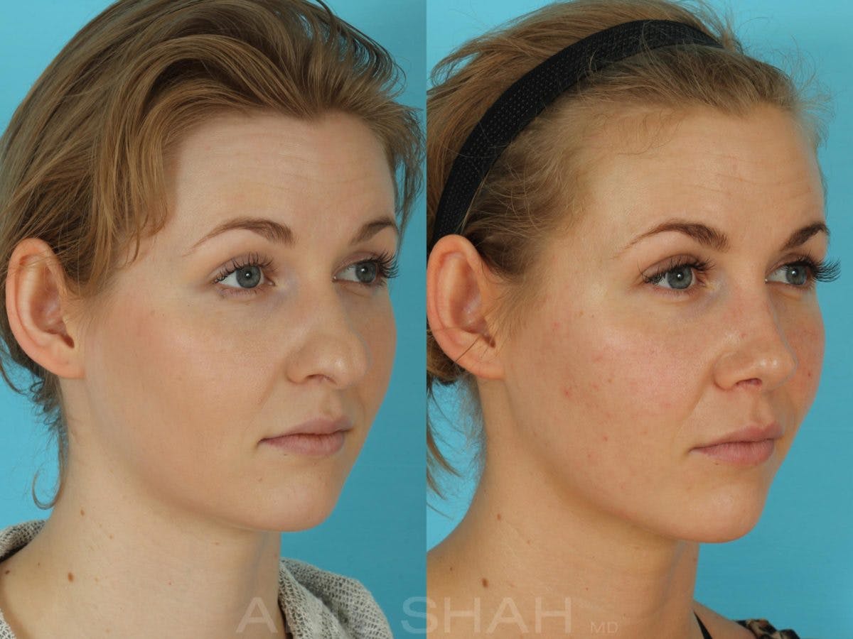 Rhinoplasty Before & After Gallery - Patient 506029 - Image 4