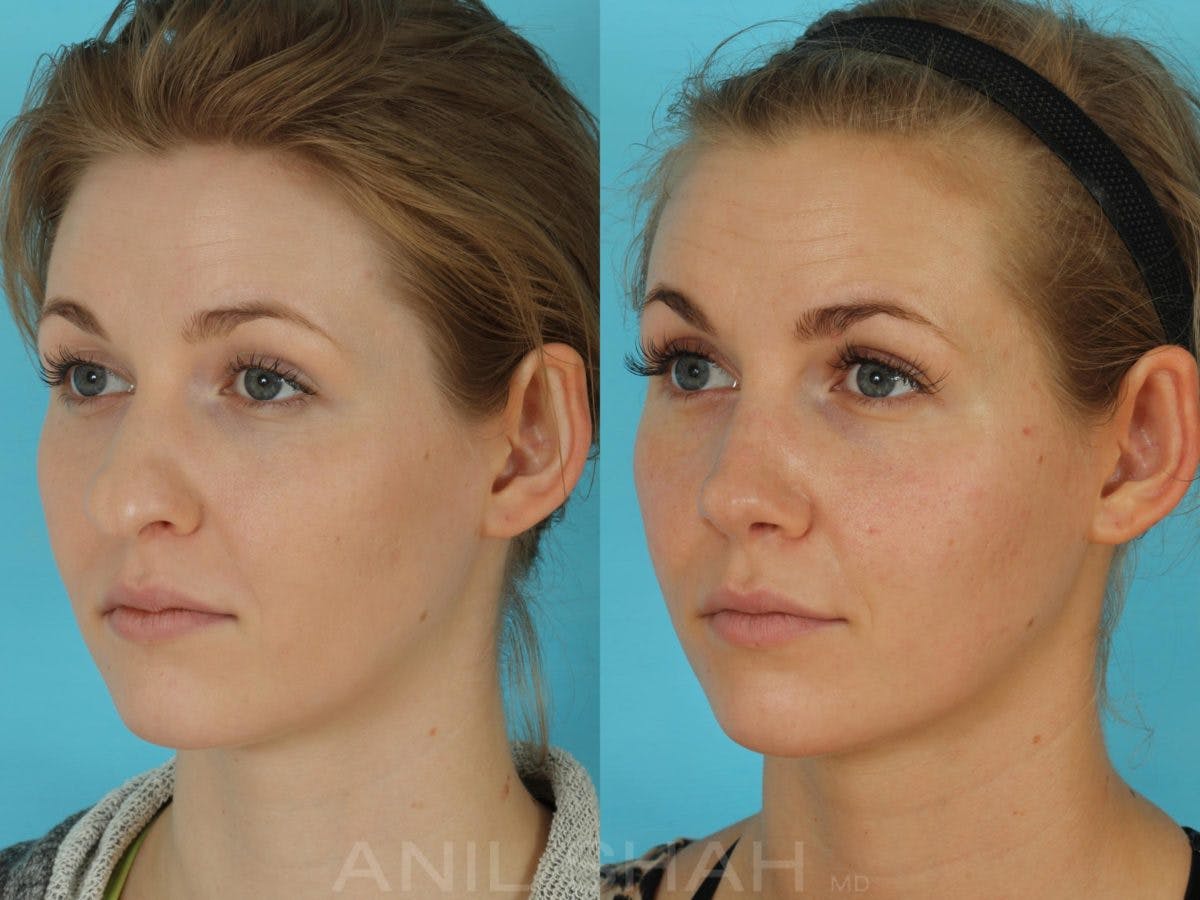 Rhinoplasty Before & After Gallery - Patient 506029 - Image 5