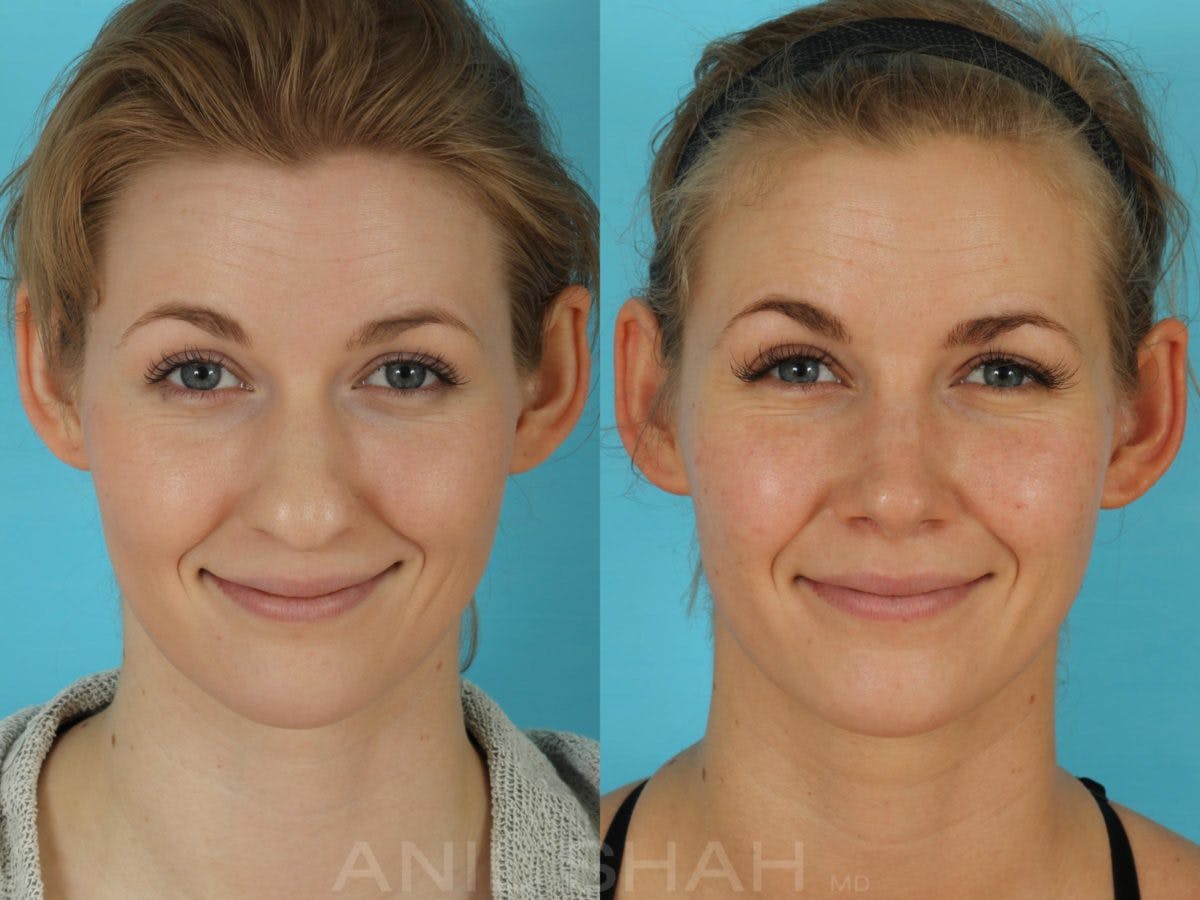 Rhinoplasty Before & After Gallery - Patient 506029 - Image 6