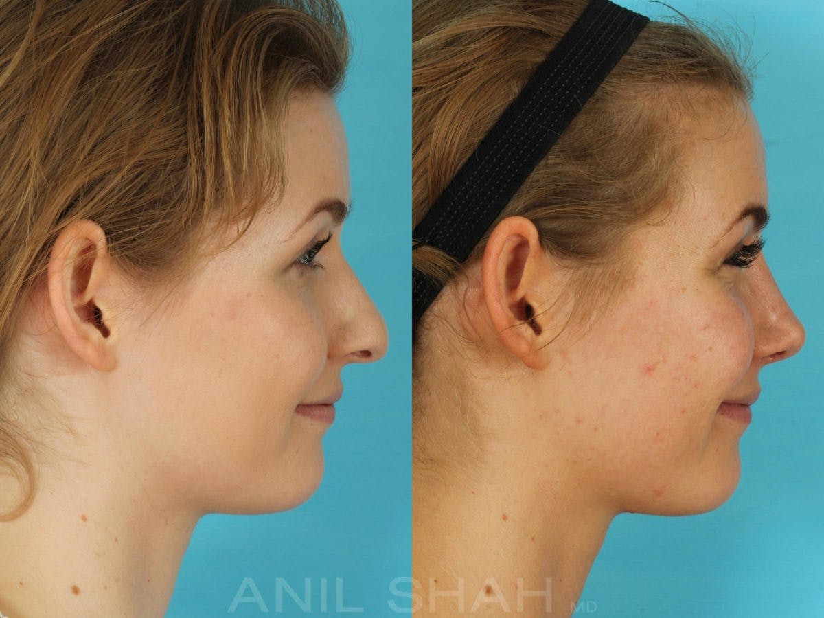 Rhinoplasty Before & After Gallery - Patient 506029 - Image 7