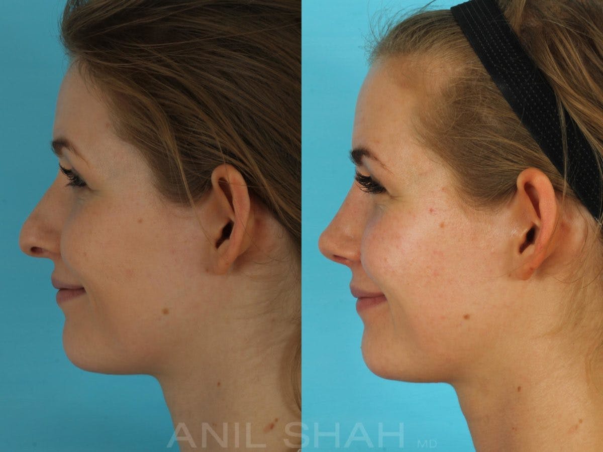 Rhinoplasty Before & After Gallery - Patient 506029 - Image 8
