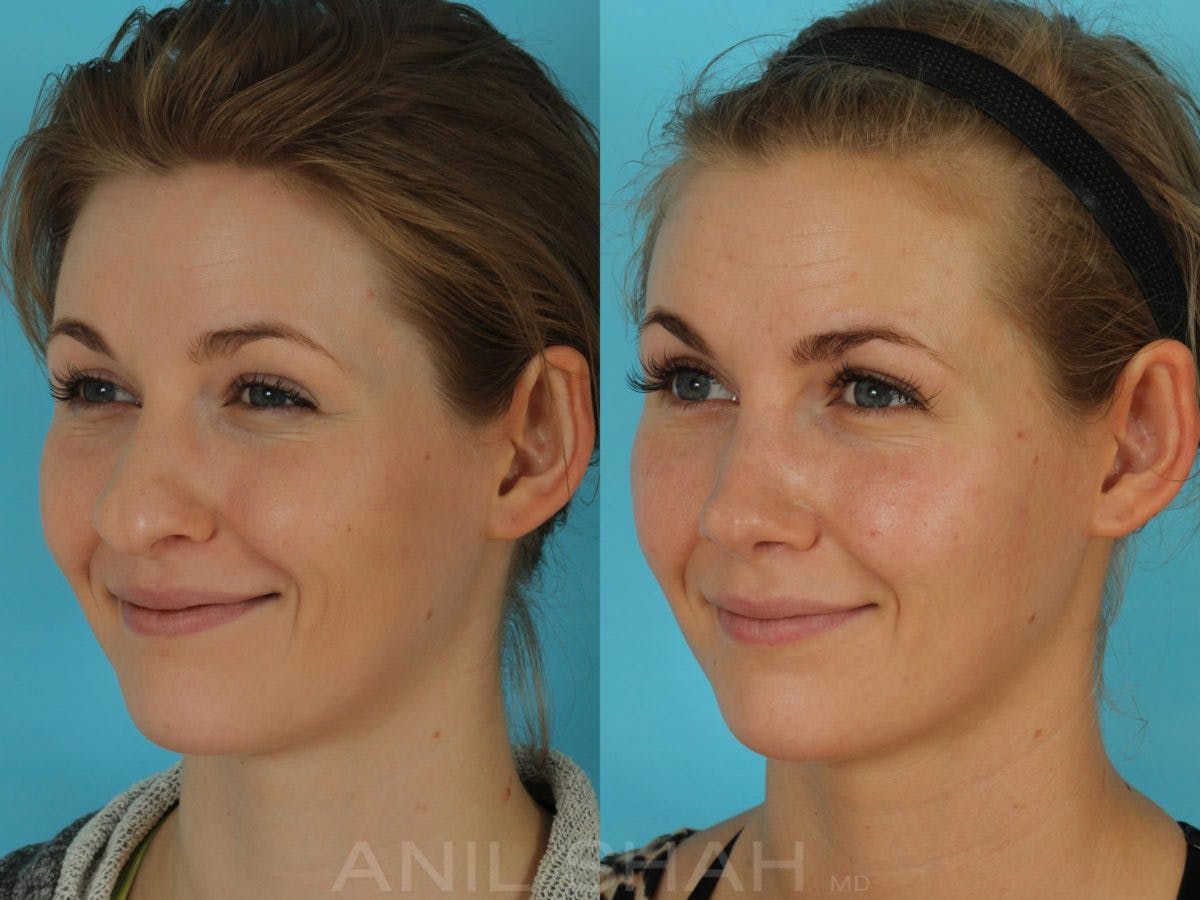 Rhinoplasty Before & After Gallery - Patient 506029 - Image 9