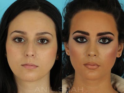 Rhinoplasty Before & After Gallery - Patient 267476 - Image 1