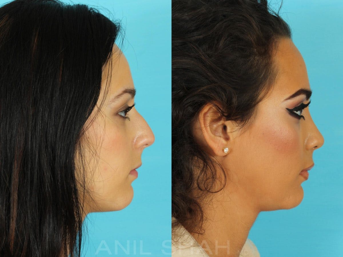 Rhinoplasty Before & After Gallery - Patient 267476 - Image 2