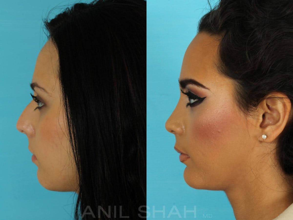 Rhinoplasty Before & After Gallery - Patient 267476 - Image 3
