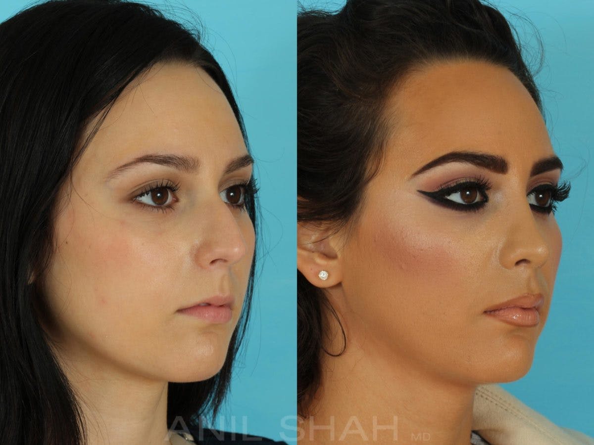 Rhinoplasty Before & After Gallery - Patient 267476 - Image 4