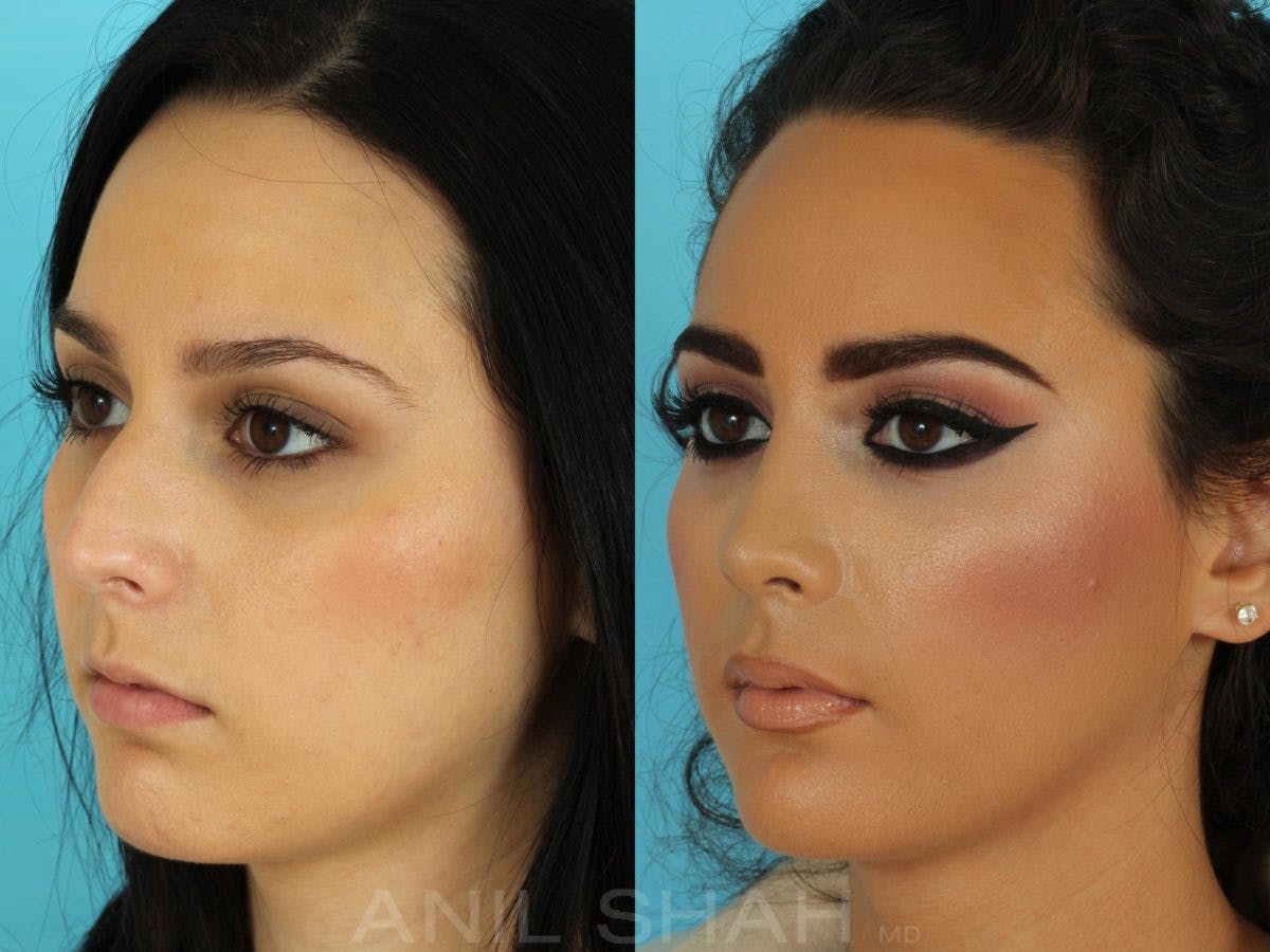 Rhinoplasty Before & After Gallery - Patient 267476 - Image 5