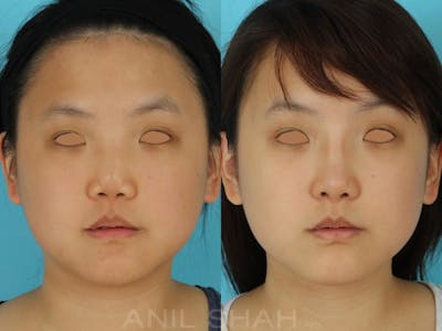 Rhinoplasty Before & After Gallery - Patient 405207 - Image 1