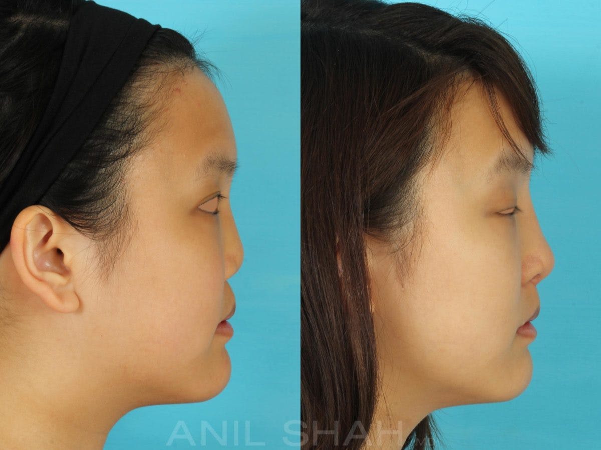 Rhinoplasty Before & After Gallery - Patient 405207 - Image 2