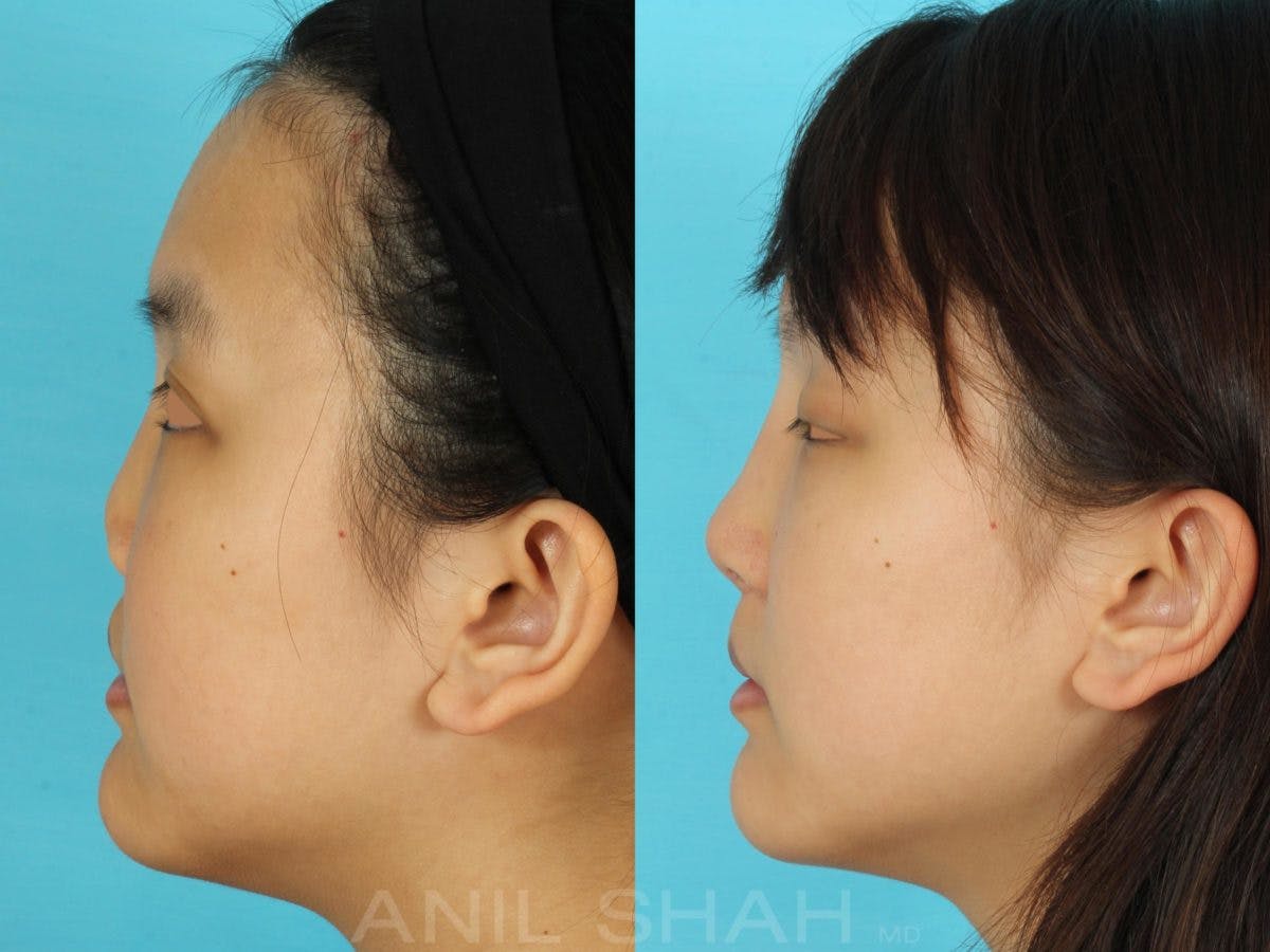 Rhinoplasty Before & After Gallery - Patient 405207 - Image 3