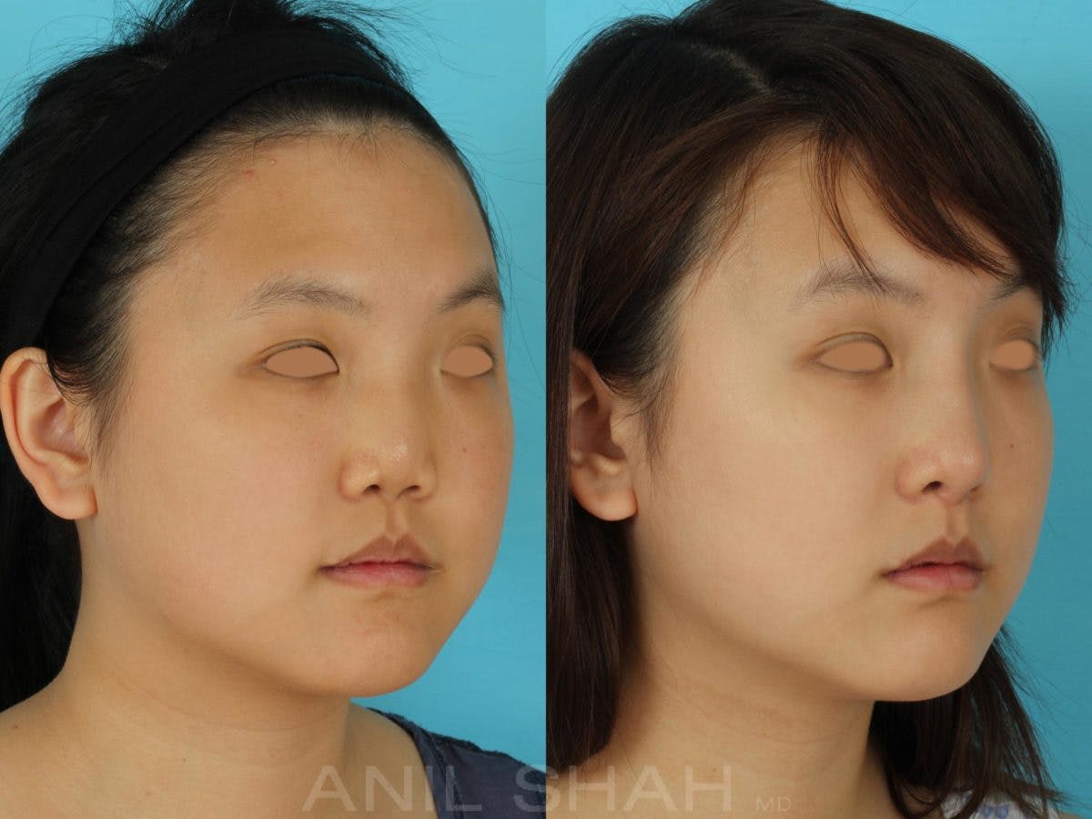Rhinoplasty Before & After Gallery - Patient 405207 - Image 4