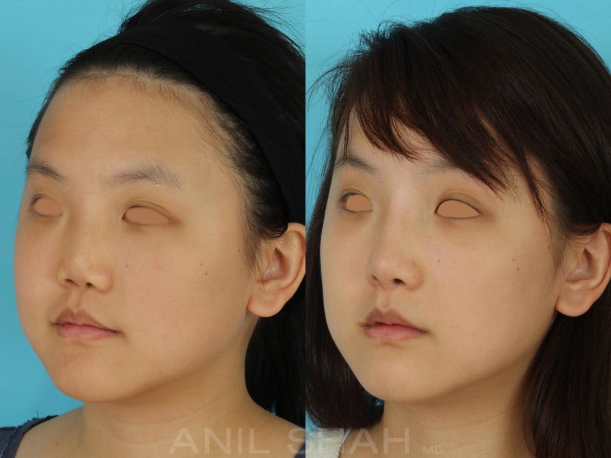 Rhinoplasty Before & After Gallery - Patient 405207 - Image 5