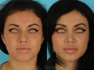 Rhinoplasty Before & After Gallery - Patient 143591 - Image 1