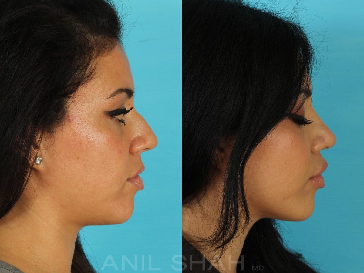 Rhinoplasty Before & After Gallery - Patient 143591 - Image 2