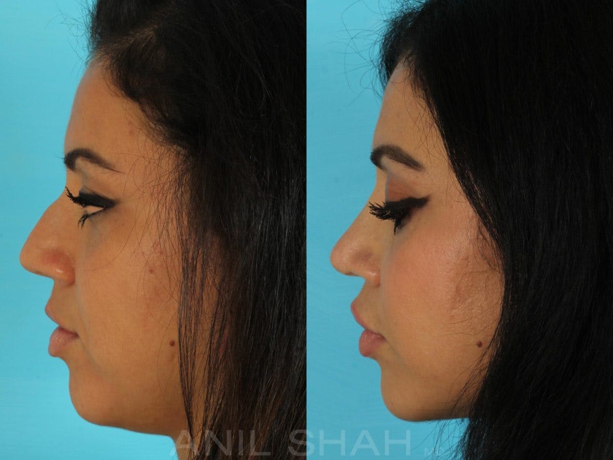 Rhinoplasty Before & After Gallery - Patient 143591 - Image 3