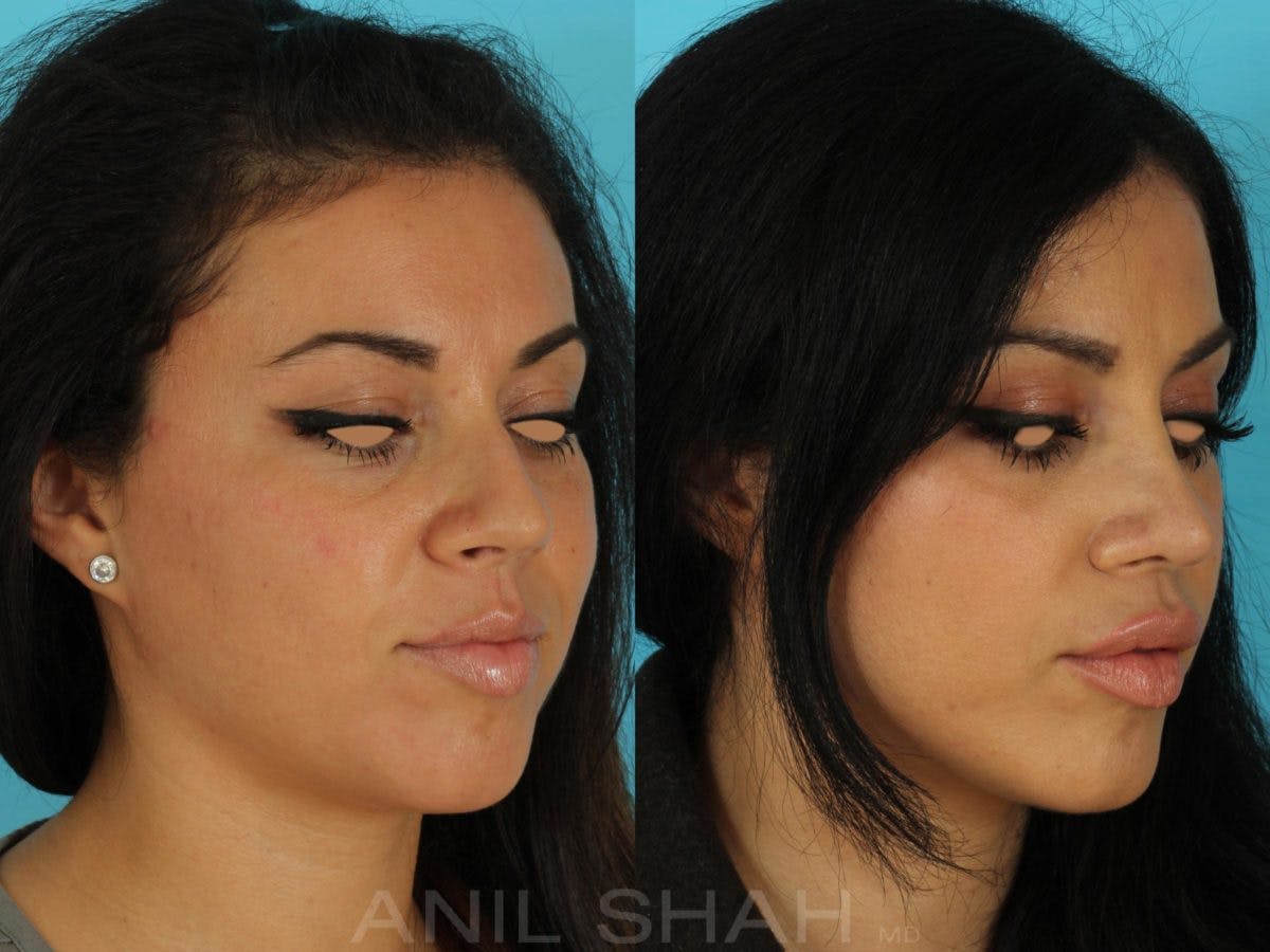 Rhinoplasty Before & After Gallery - Patient 143591 - Image 4