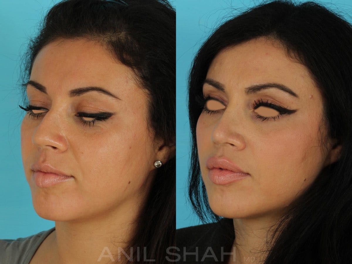 Rhinoplasty Before & After Gallery - Patient 143591 - Image 5