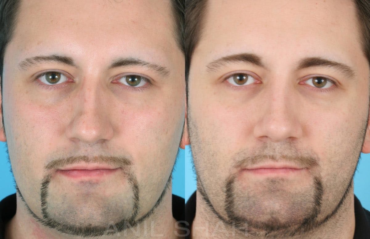 Rhinoplasty Before & After Gallery - Patient 137295 - Image 1