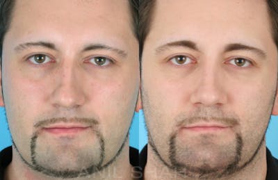 Rhinoplasty Before & After Gallery - Patient 137295 - Image 1