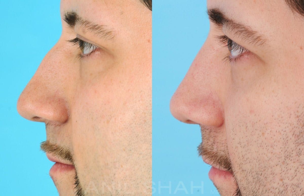 Rhinoplasty Before & After Gallery - Patient 137295 - Image 2