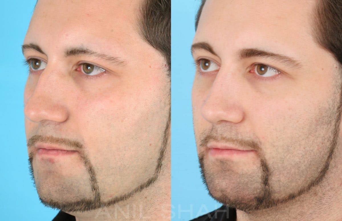 Rhinoplasty Before & After Gallery - Patient 137295 - Image 3