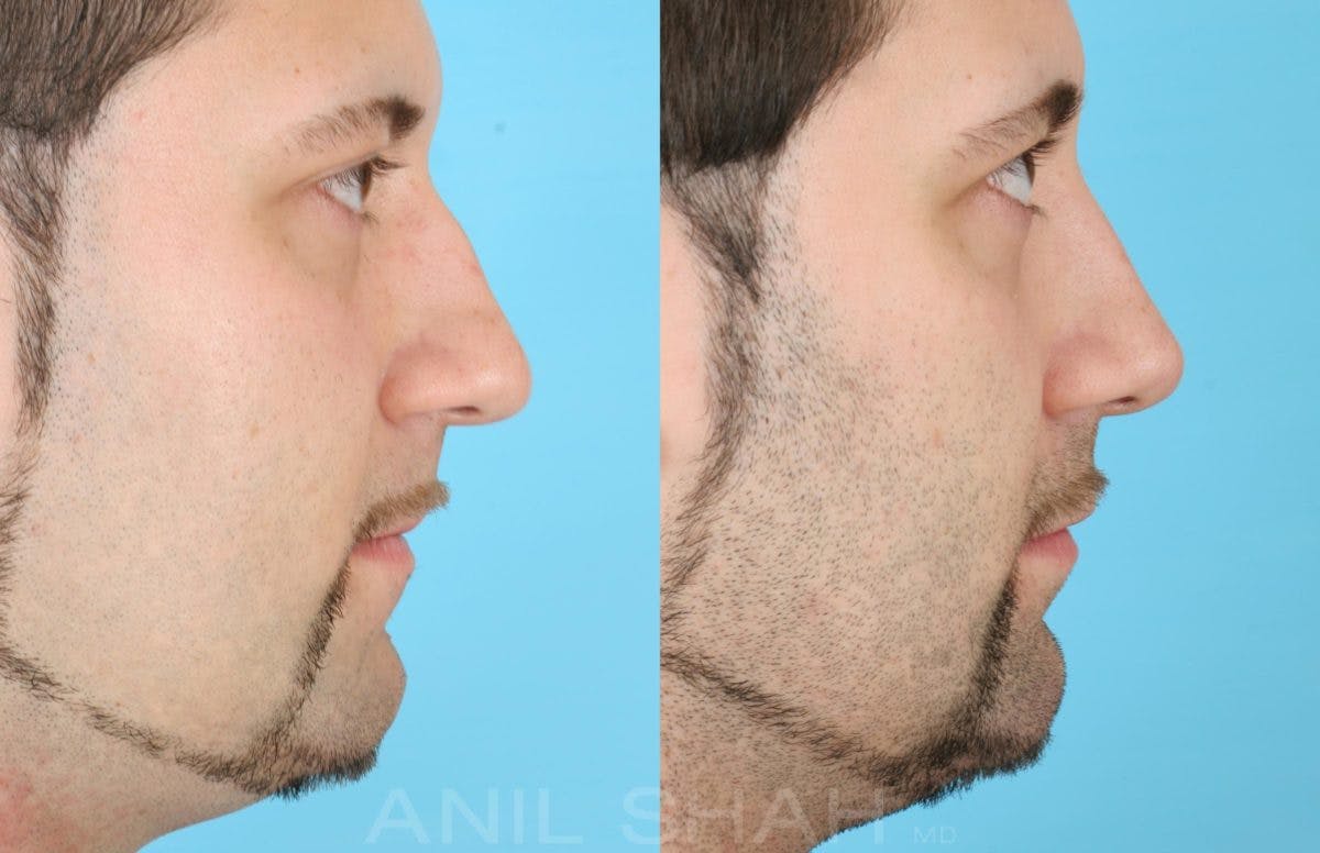 Rhinoplasty Before & After Gallery - Patient 137295 - Image 4