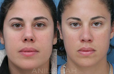 Rhinoplasty Before & After Gallery - Patient 531143 - Image 1