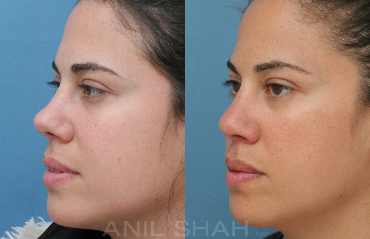 Rhinoplasty Before & After Gallery - Patient 531143 - Image 2