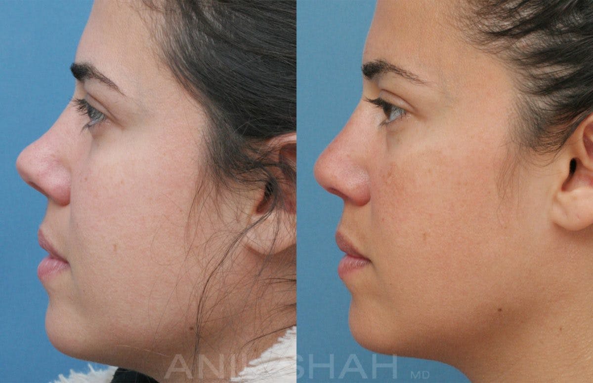 Rhinoplasty Before & After Gallery - Patient 531143 - Image 3