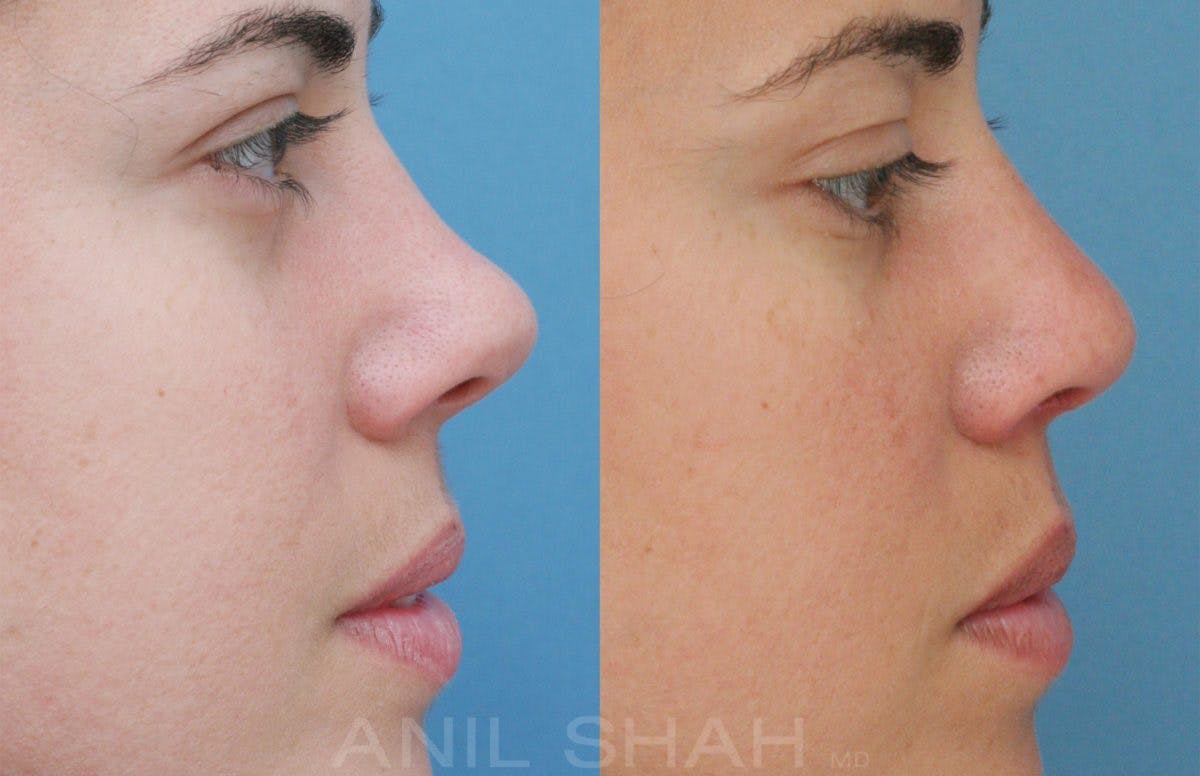 Rhinoplasty Before & After Gallery - Patient 531143 - Image 4