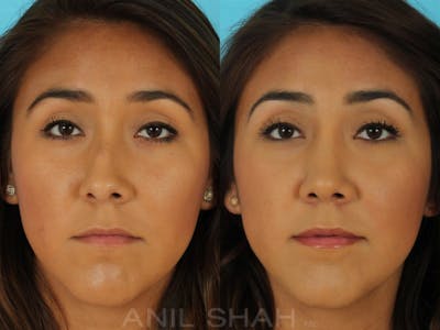 Rhinoplasty Before & After Gallery - Patient 165389 - Image 1