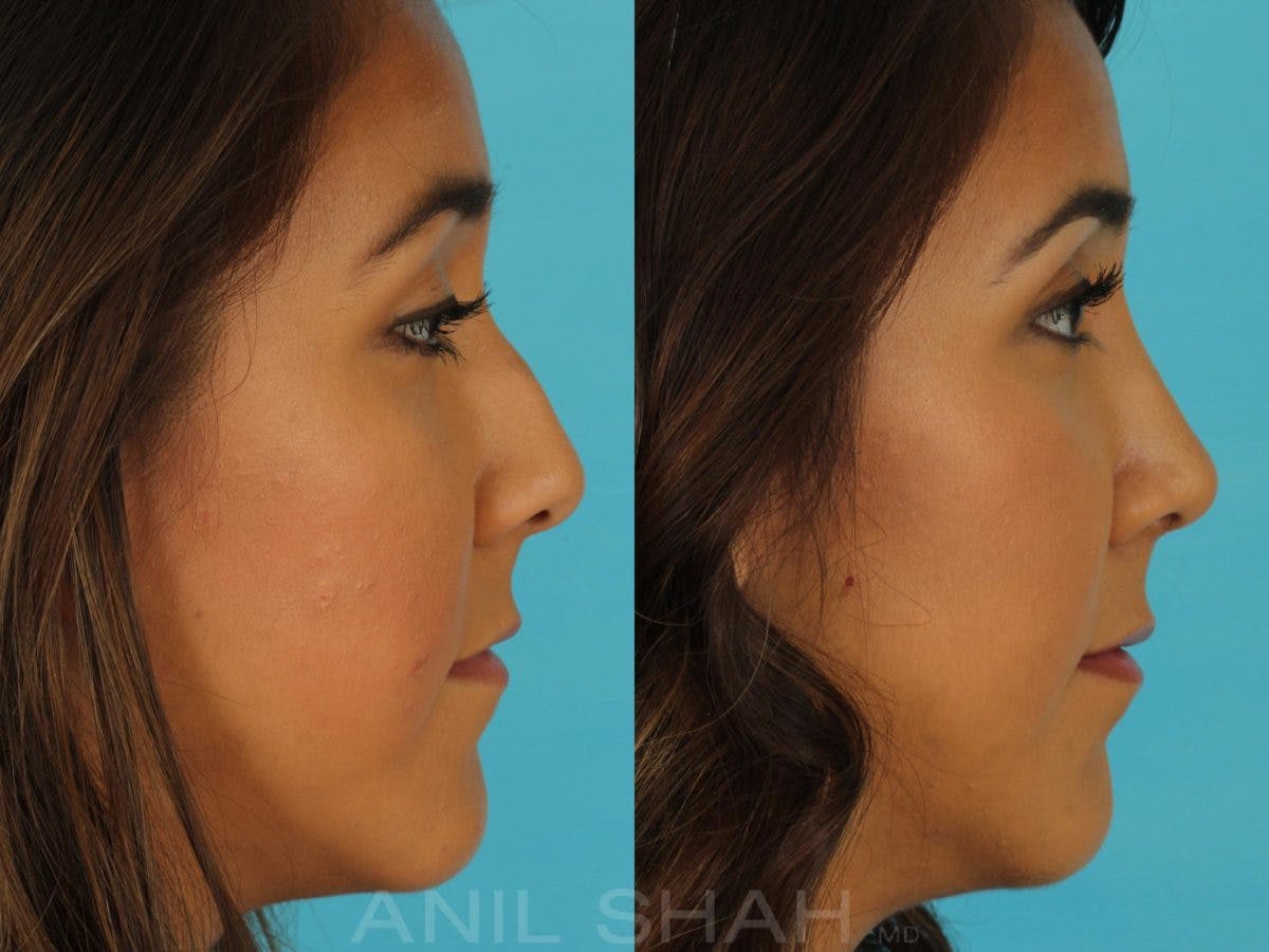 Rhinoplasty Before & After Gallery - Patient 165389 - Image 2