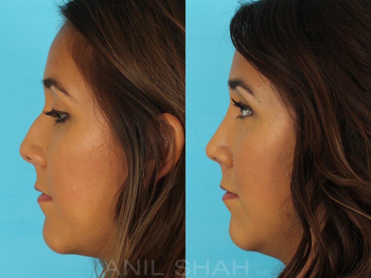 Rhinoplasty Before & After Gallery - Patient 165389 - Image 3