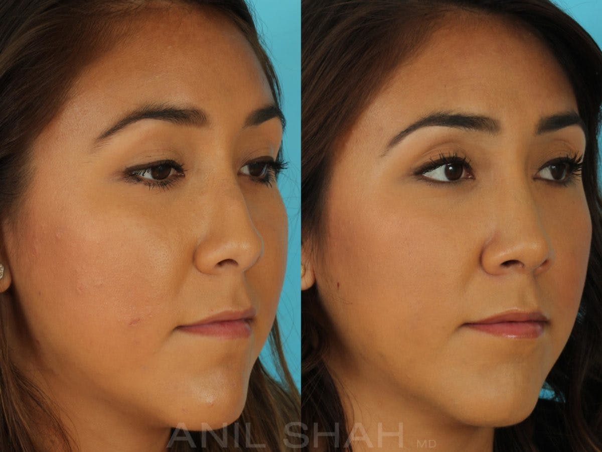 Rhinoplasty Before & After Gallery - Patient 165389 - Image 4