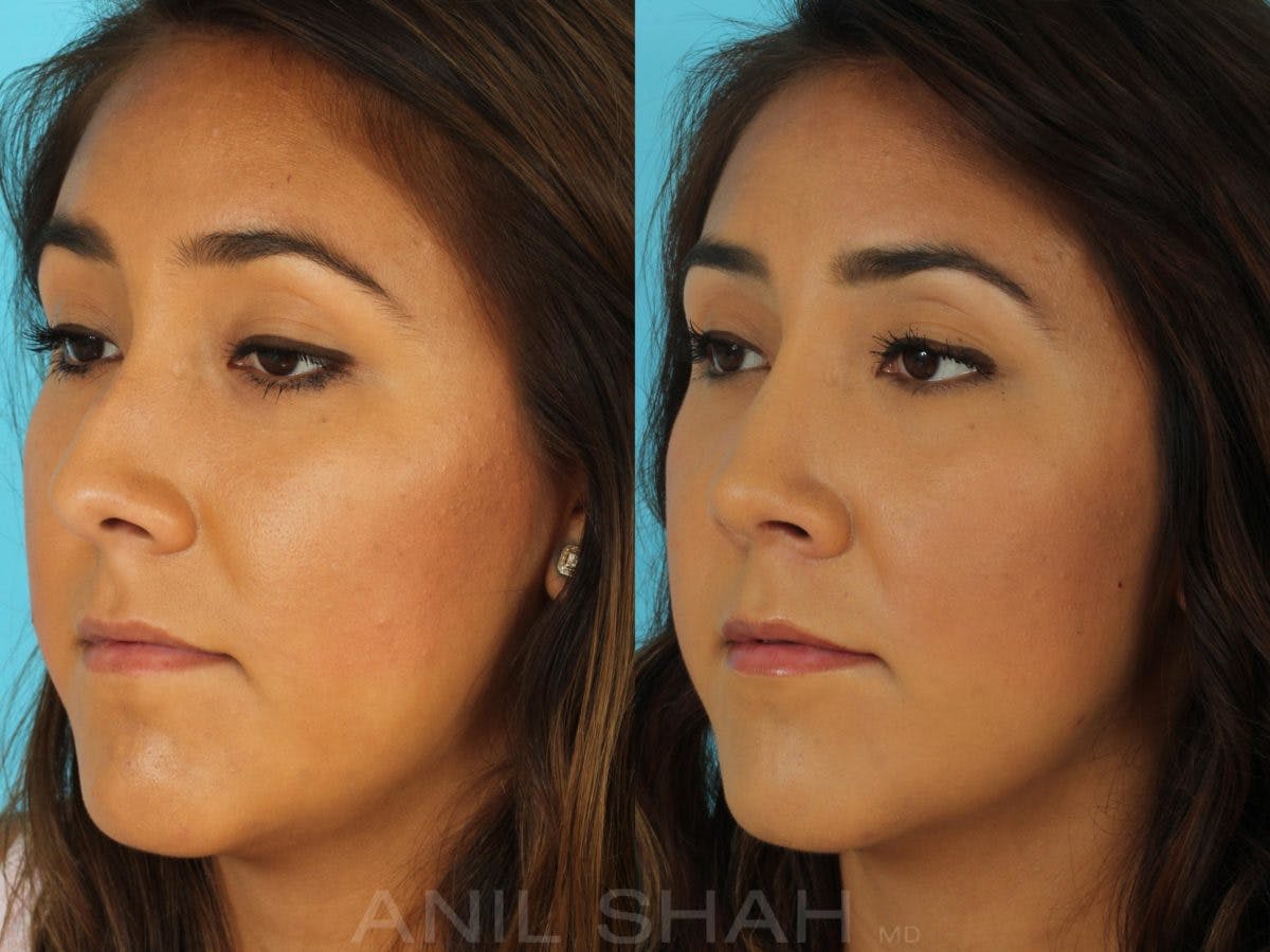Rhinoplasty Before & After Gallery - Patient 165389 - Image 5