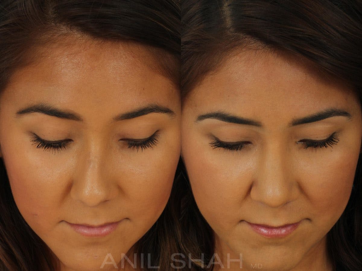 Rhinoplasty Before & After Gallery - Patient 165389 - Image 6
