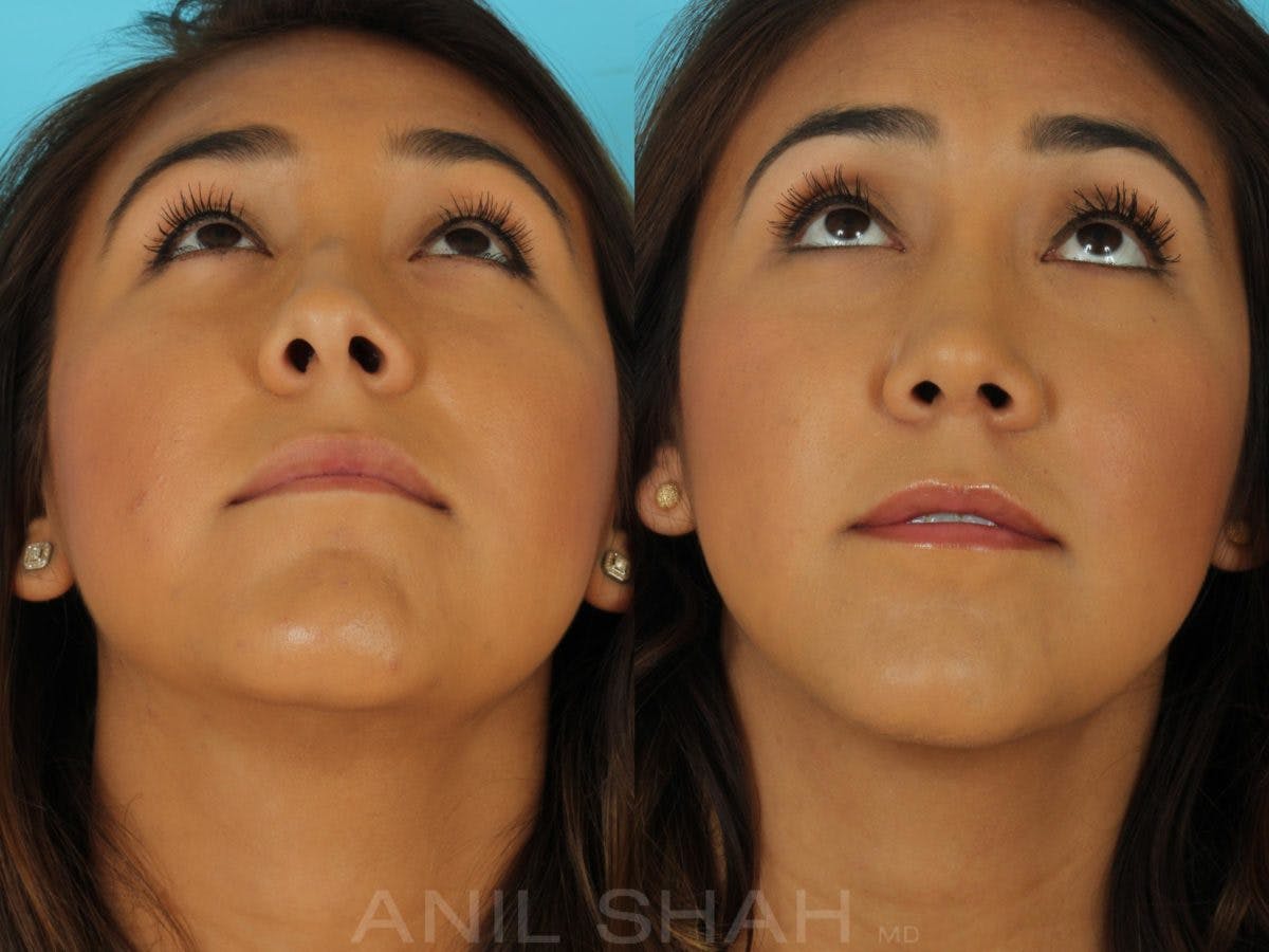 Rhinoplasty Before & After Gallery - Patient 165389 - Image 7